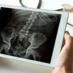 Innovative technology could transform osteoporosis diagnosis using routine x-rays