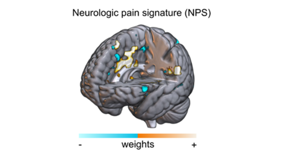                       The brain response shows overall brain activity involved in processing the location and intensity of pain. This response was low