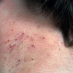 Exeter secures £3.3 million grant to investigate treatment and prevention of eczema